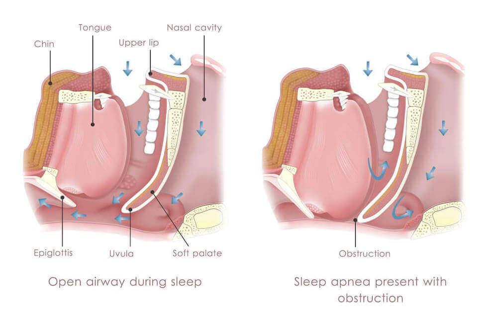 sleep apnea diagram